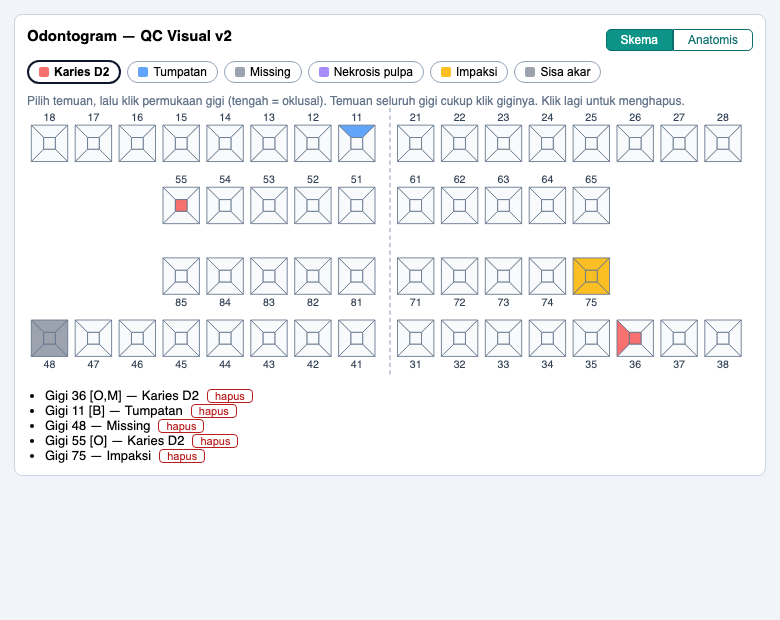 Odontogram interaktif 52 gigi (permanen + susu): klik langsung per permukaan